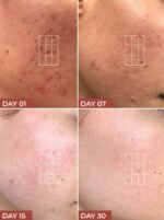 Acne Scar Treatment Gel - Image 4