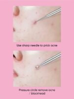 Beautenic Blackhead Remover - Image 4