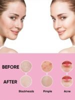 Beautenic Blackhead Remover - Image 5