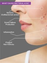 Benzoyl Peroxide 2.5% Acne Treatment Toner - Image 4